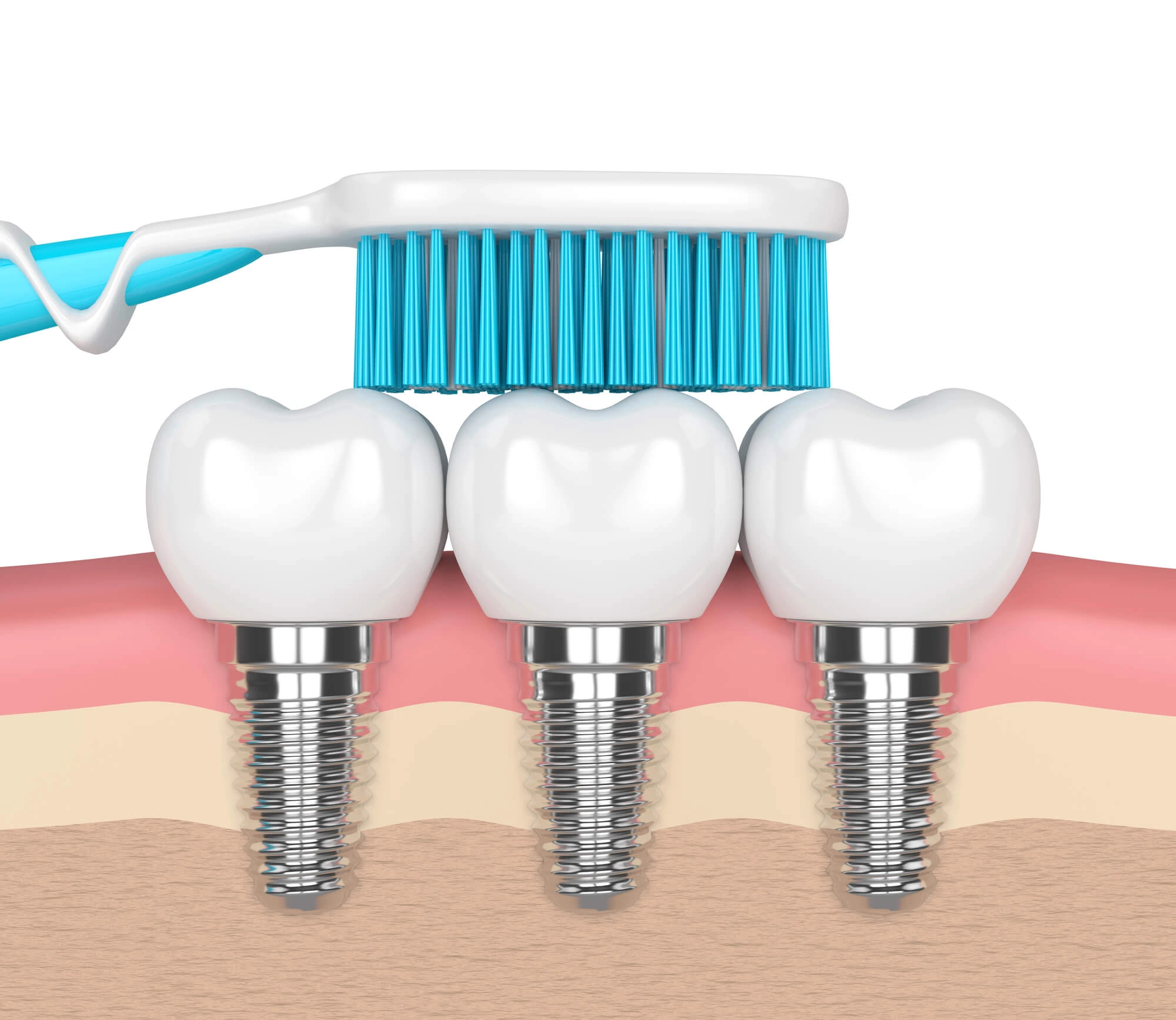 3D illustration of brushing dental implants Chesapeake VA