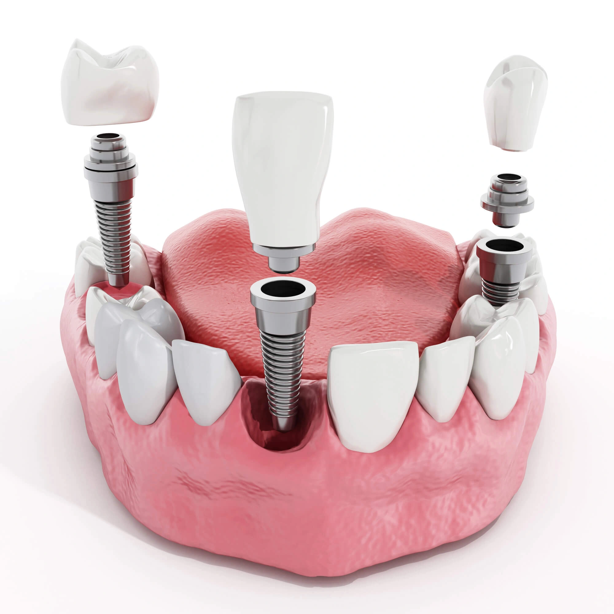 dental implants in Virginia Beach 