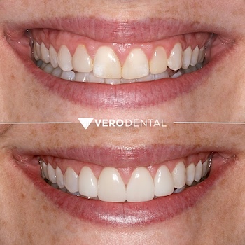 Before and after comparison of close up mouth smiling