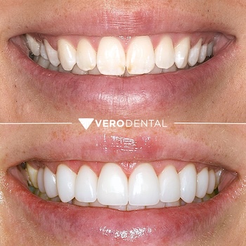 Before and after comparison of close up mouth smiling