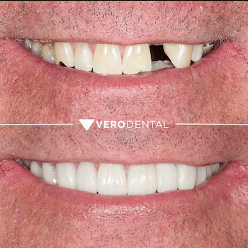 Before and after comparison of close up mouth smiling