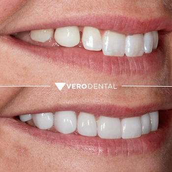 Before and after comparison of close up mouth smiling