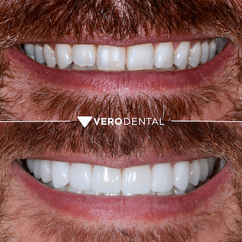 Before and after comparison of close up mouth smiling