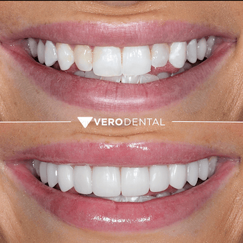 Before and after comparison of close up mouth smiling