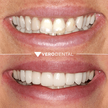 Before and after comparison of close up mouth smiling