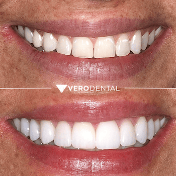 Before and after comparison of close up mouth smiling