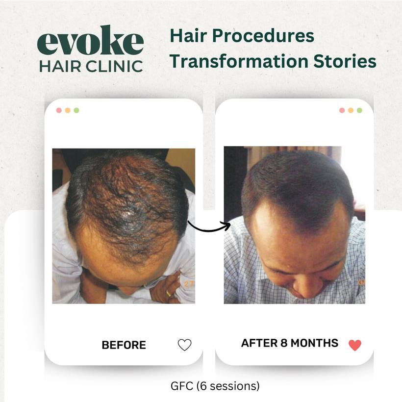 GFC hair restoration before and after over 8 months at Evoke Hair Clinic