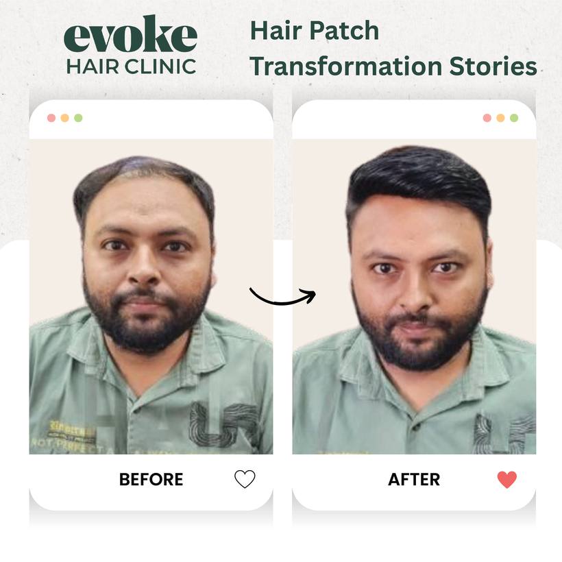 Hair patch before and after transformation at Evoke Hair Clinic