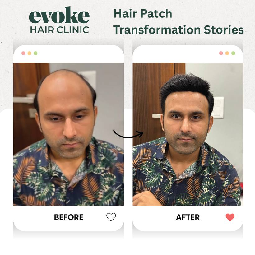 Hair patch before and after transformation at Evoke Hair Clinic