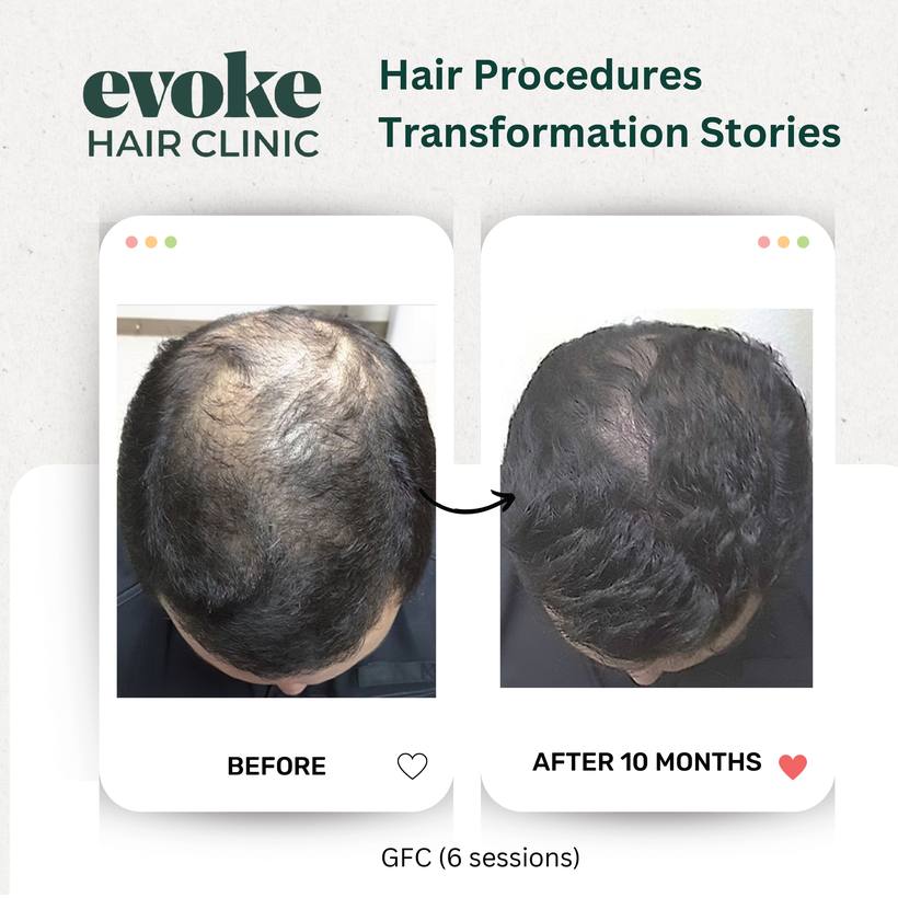 GFC hair restoration before and after over 10 months at Evoke Hair Clinic