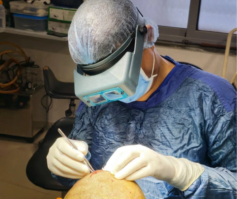 Cost of Hair Transplant in India