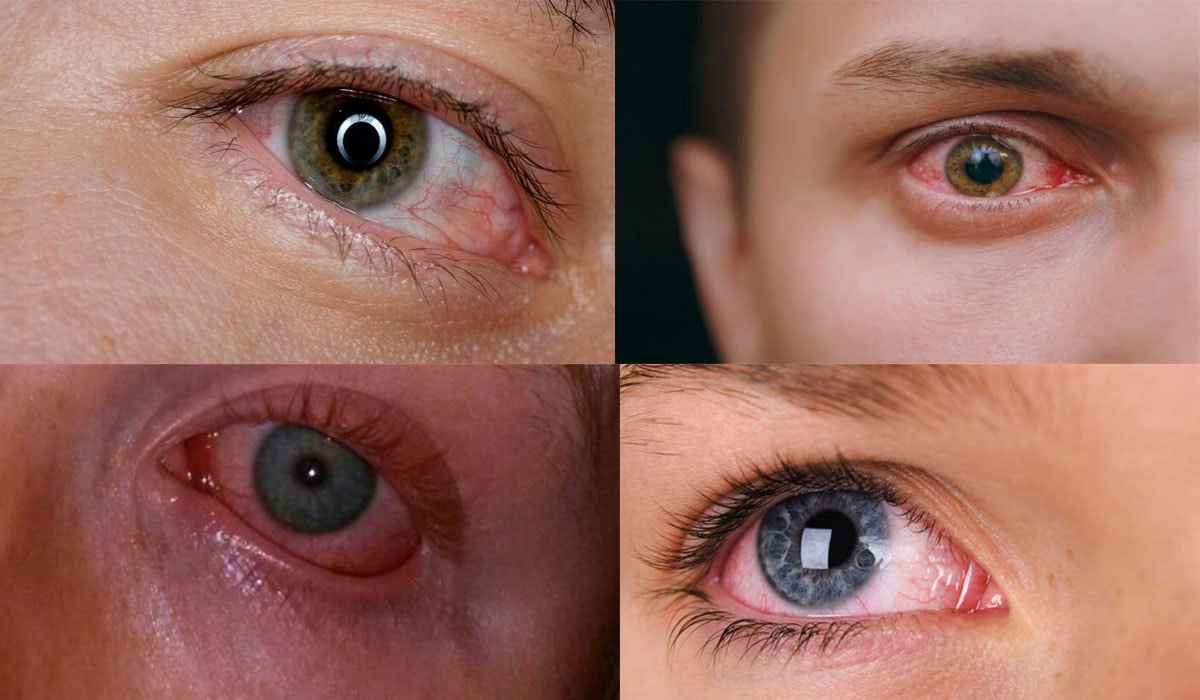 A visual representation of individuals at risk for opioid-related eye complications, focusing on high-risk groups.