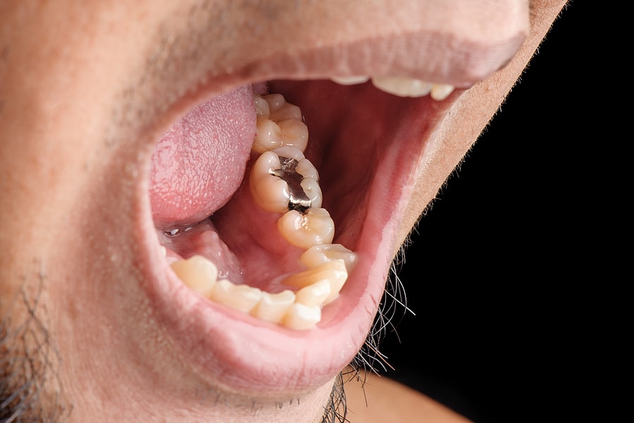 An illustration showing the impact of Suboxone on oral health, highlighting dental problems.