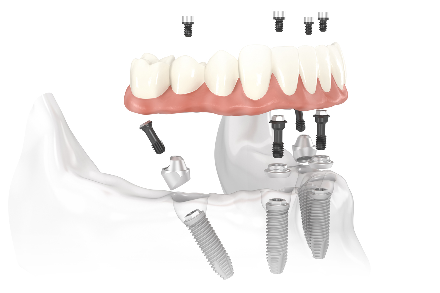Illustration of a complete lower dental arch supported by four implants