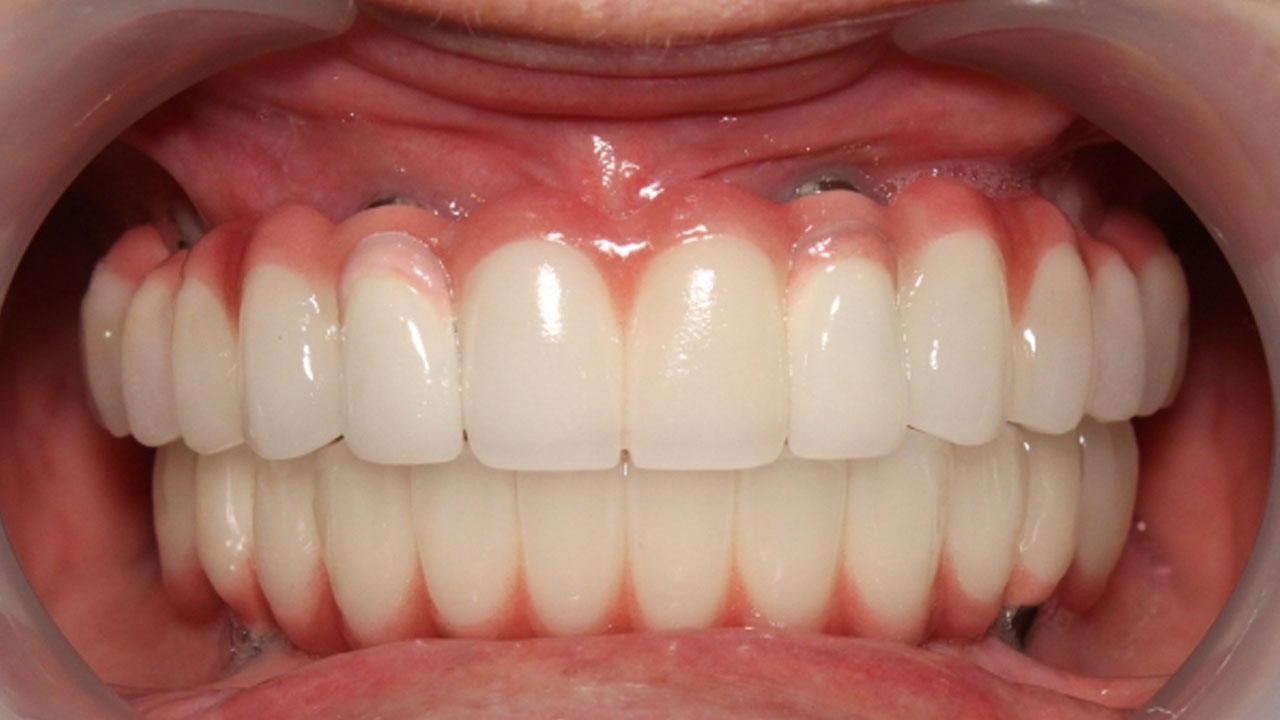 External example of a restored upper and lower full arch smile after implant treatment