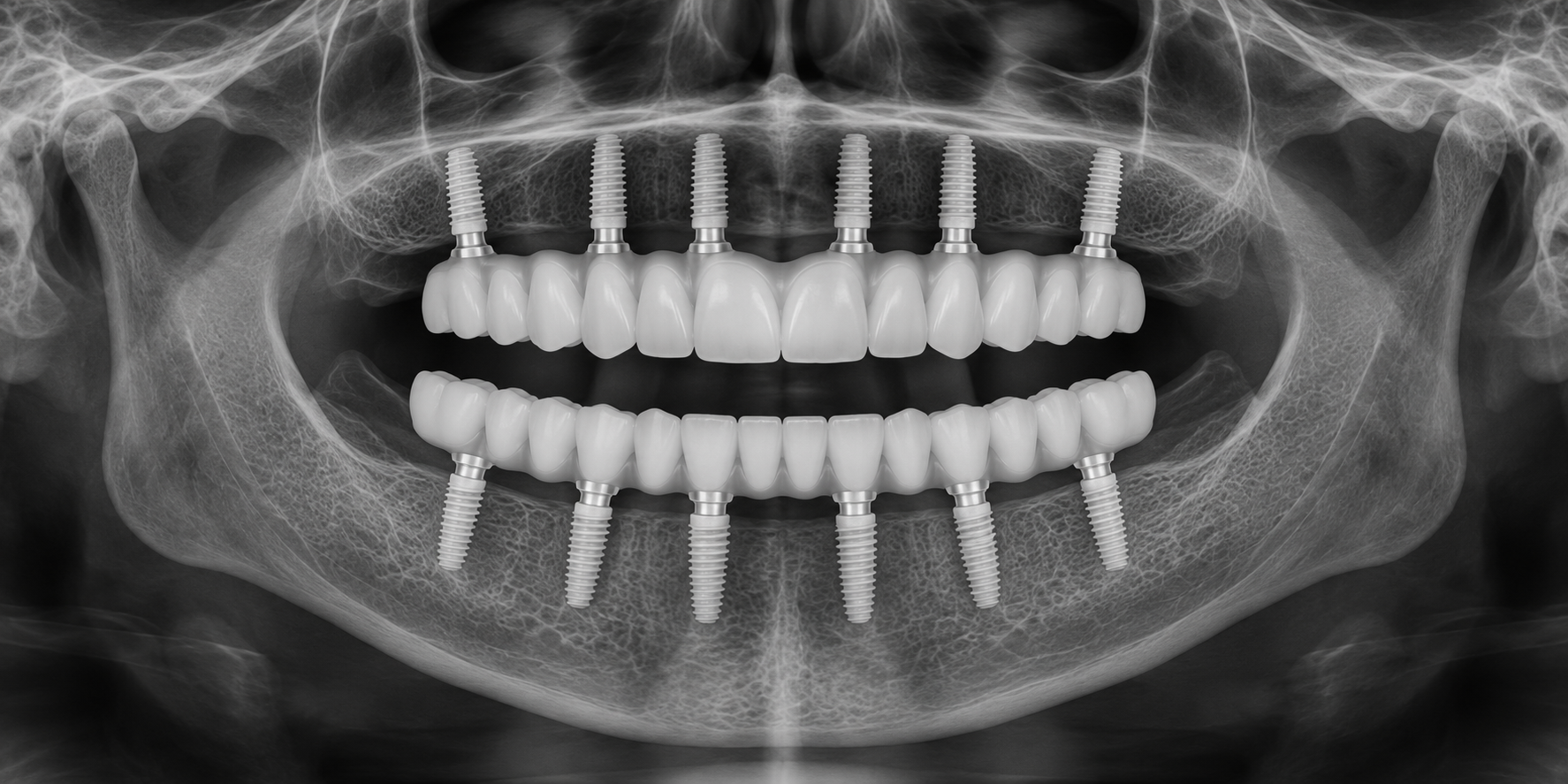 Illustrative panoramic view of complete upper and lower arches supported by multiple implants; not a patient X-ray