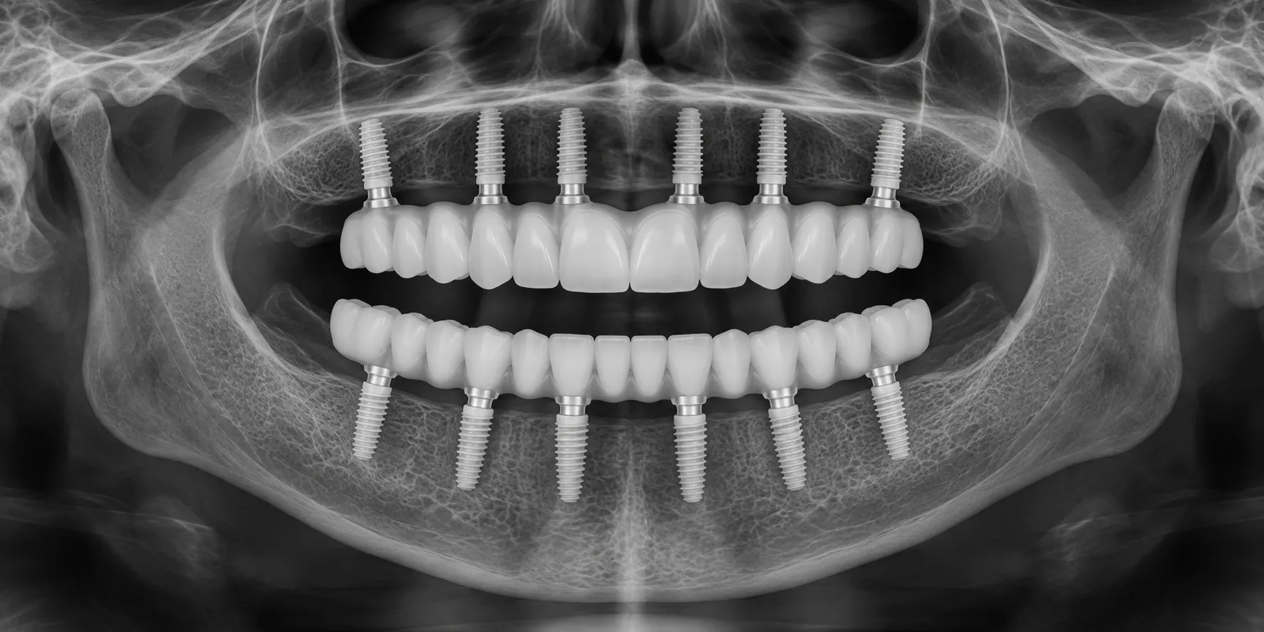 Illustrative panoramic view of complete upper and lower arches supported by multiple implants; not a patient X-ray