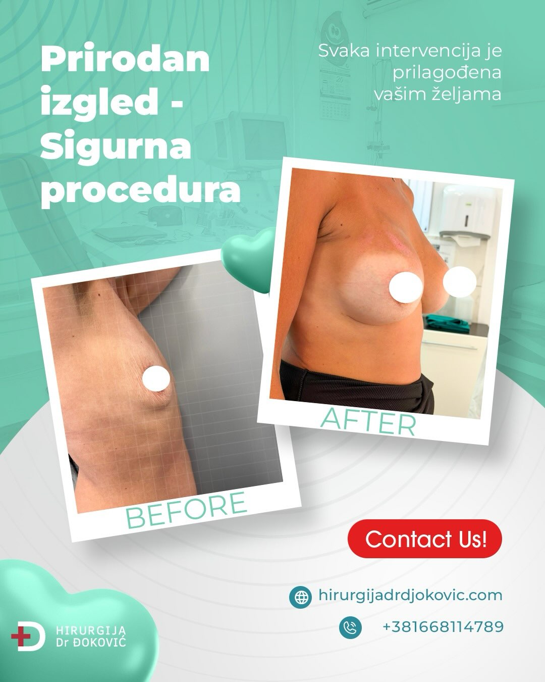 Operacija grudi pre i posle – rezultat 8