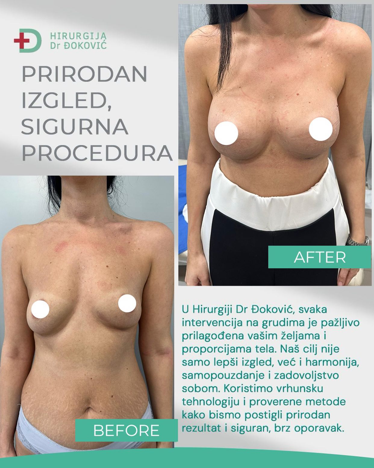 Operacija grudi pre i posle – rezultat 1