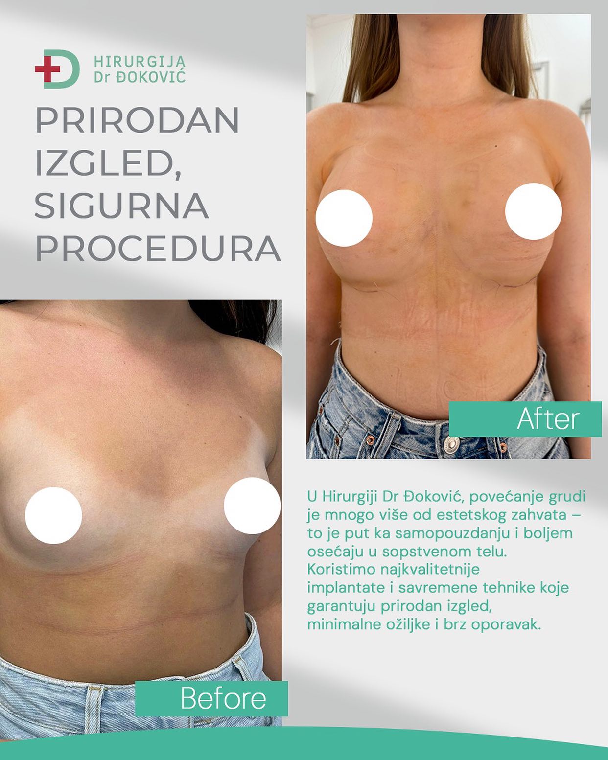 Operacija grudi pre i posle – rezultat 2