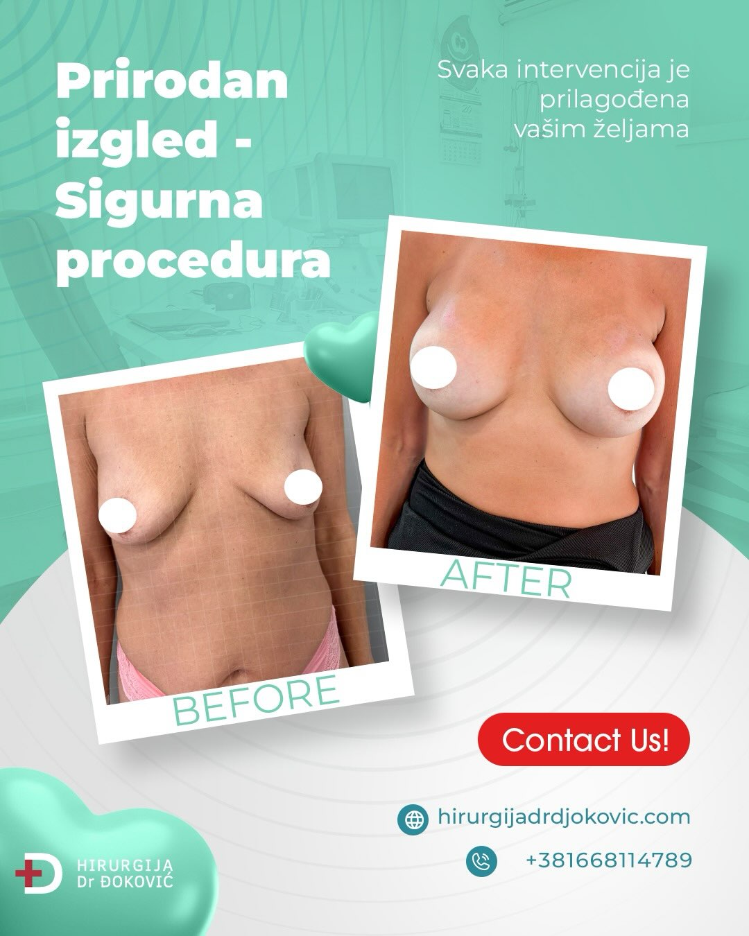 Operacija grudi pre i posle – rezultat 5