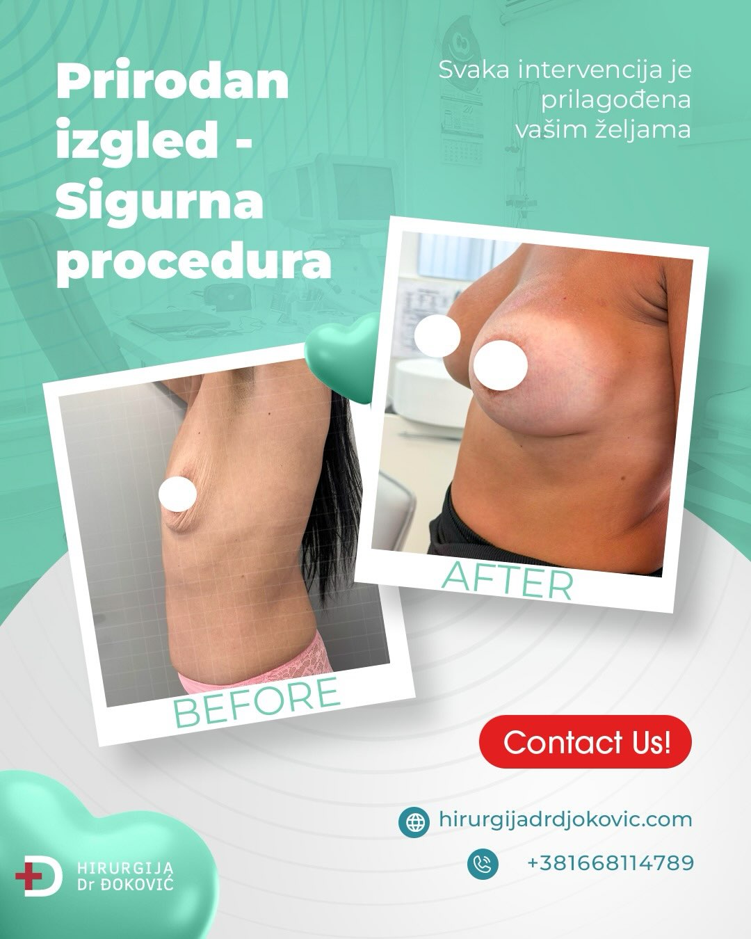 Operacija grudi pre i posle – rezultat 6