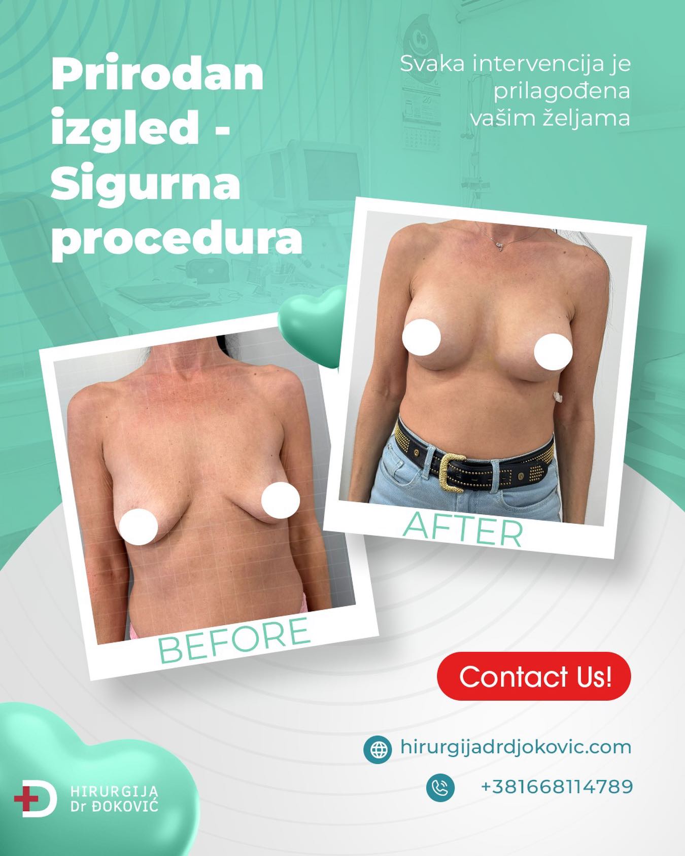 Povećanje grudi pre i posle – silikonske grudi, rezultat 2