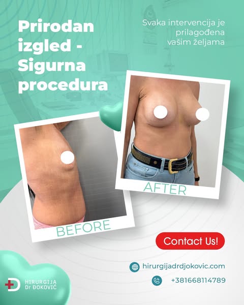 Uvećanje grudi pre i posle – silikonski implanti, rezultat 16