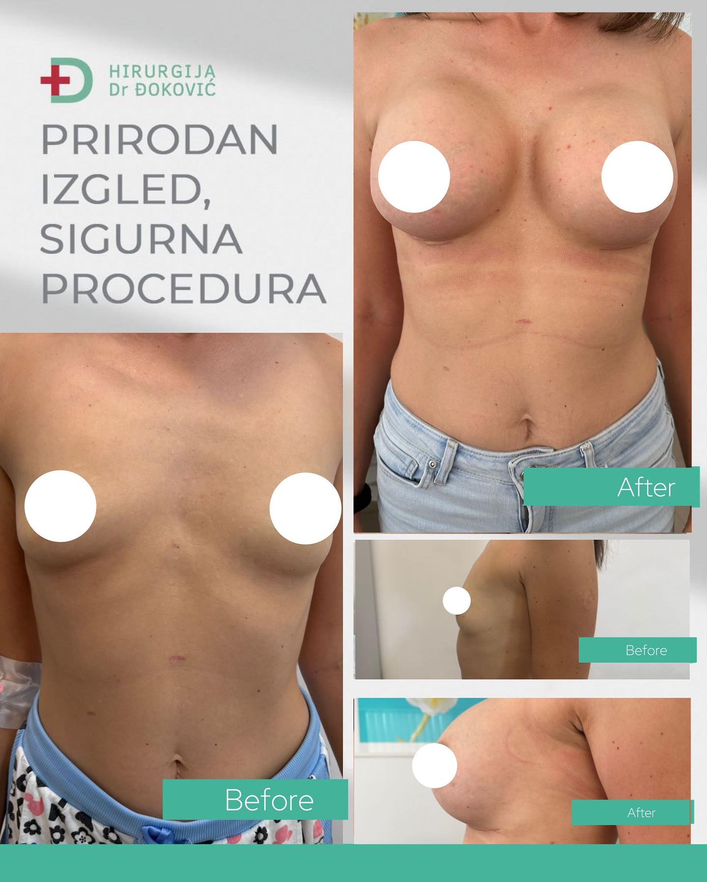 Uvećanje grudi pre i posle – silikonski implanti, rezultat 15