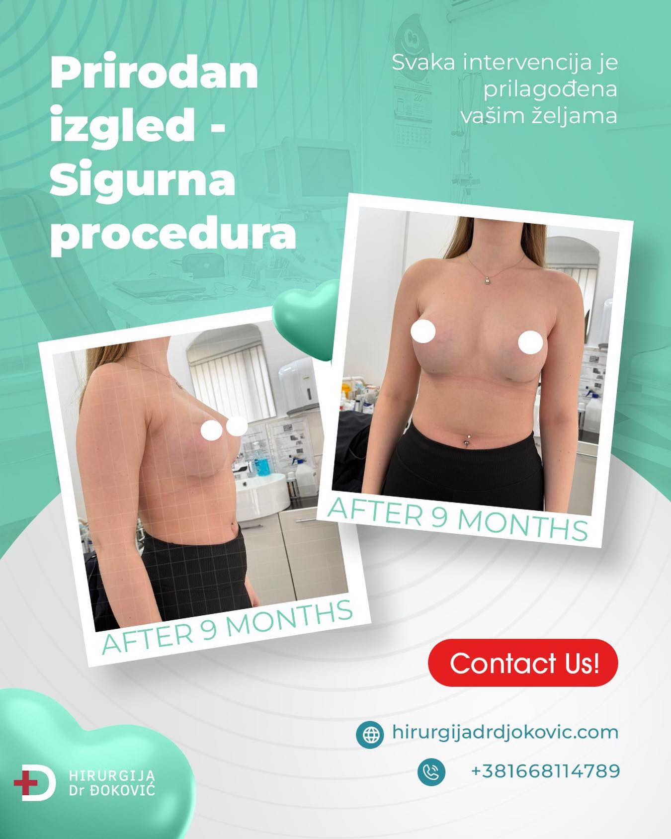 Uvećanje grudi pre i posle – silikonski implanti, rezultat 13