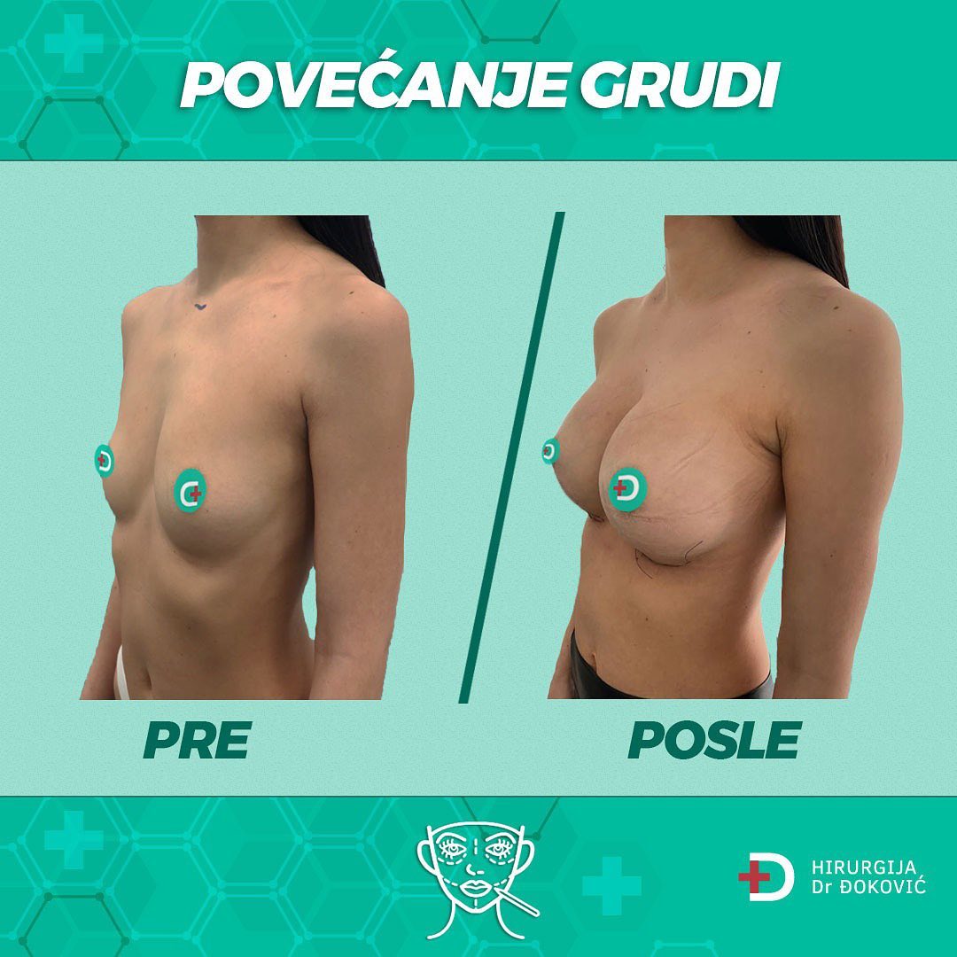 Povećanje grudi pre i posle – silikonske grudi, rezultat 4