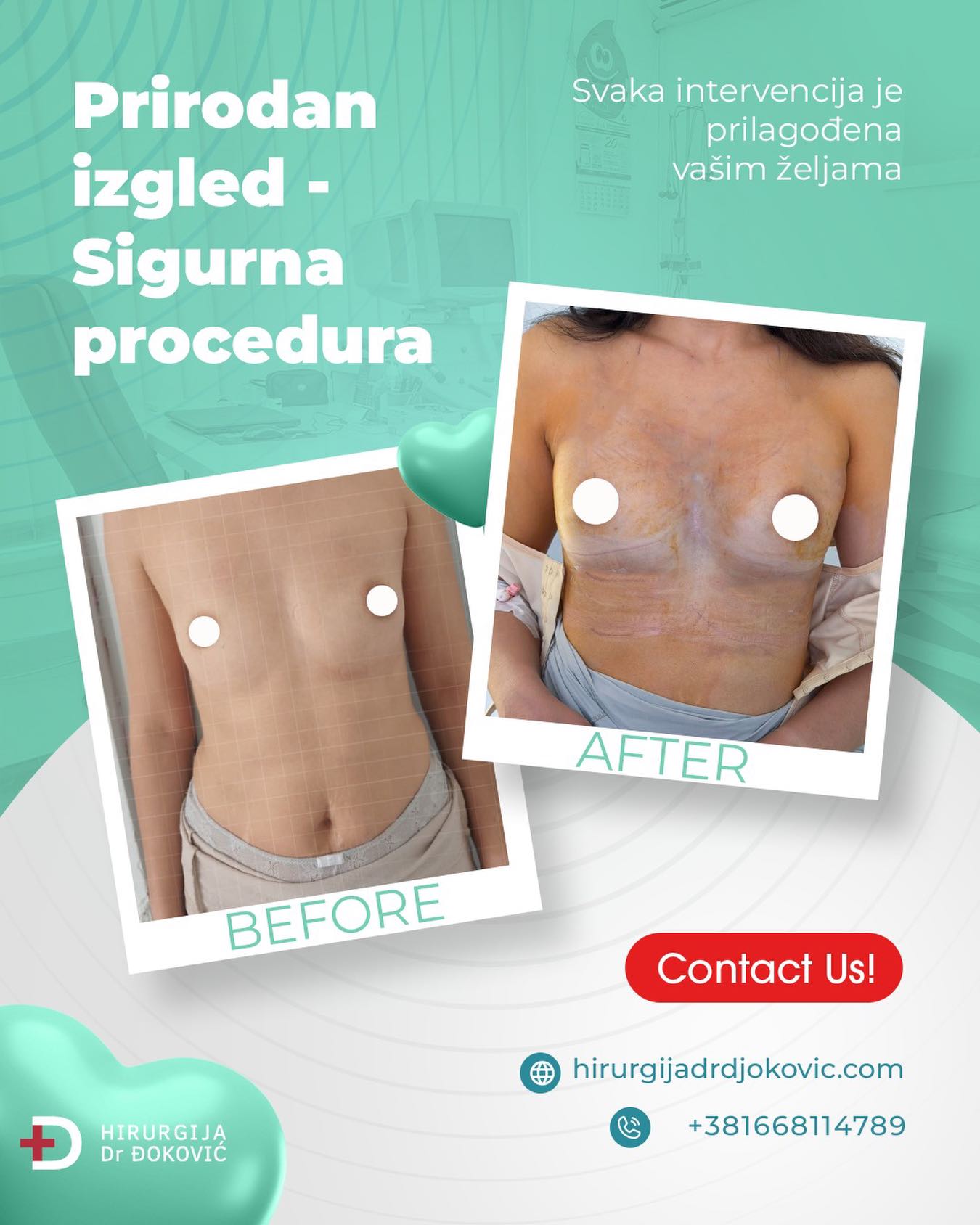Povećanje grudi pre i posle – silikonske grudi, rezultat 3