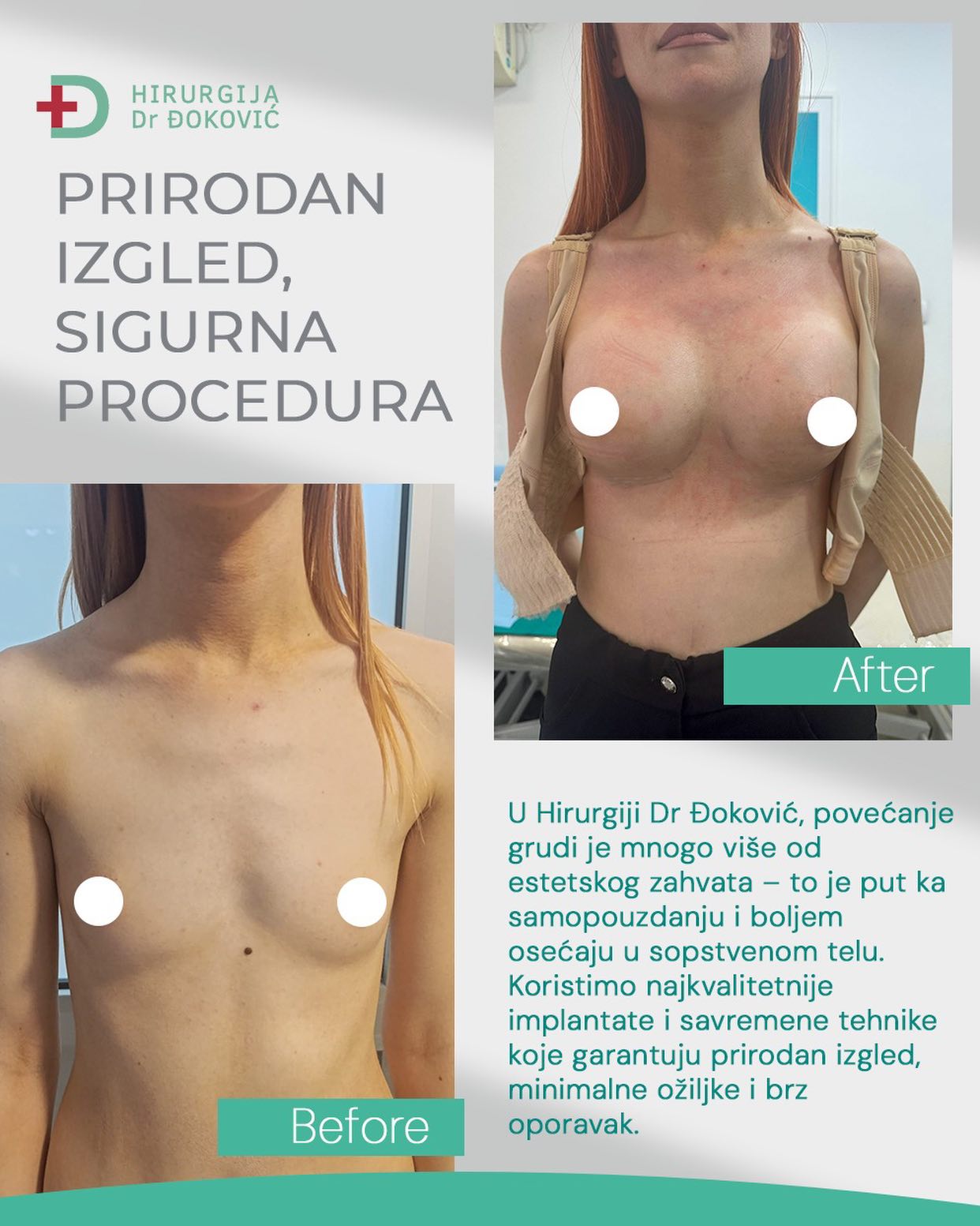 Operacija grudi pre i posle – rezultat 3
