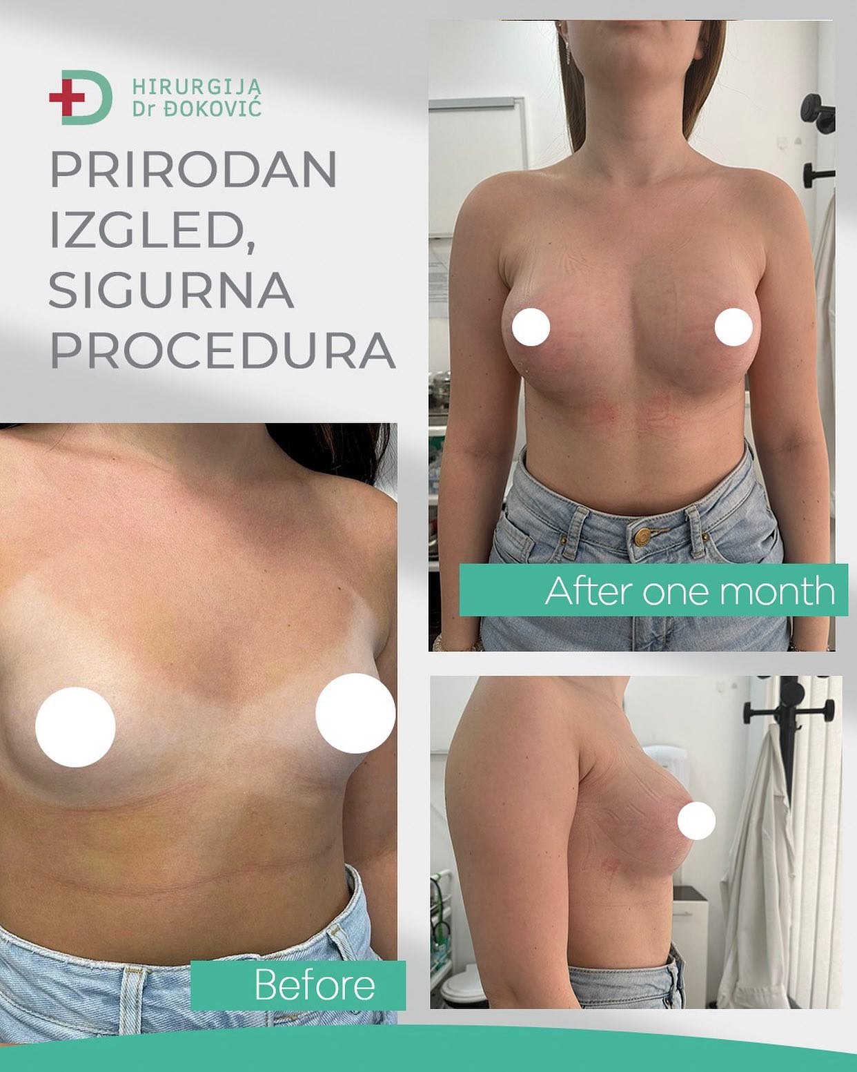 Operacija grudi pre i posle – rezultat 4