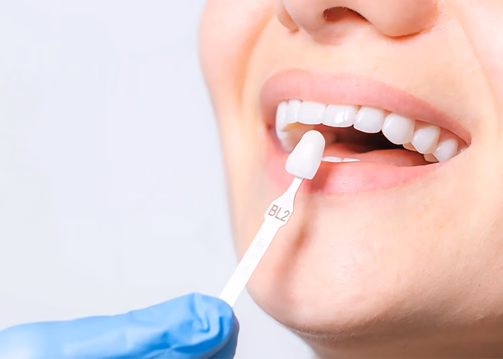Closeup of the color-matching process for dental veneers at the best cosmetic dentist in San Francisco