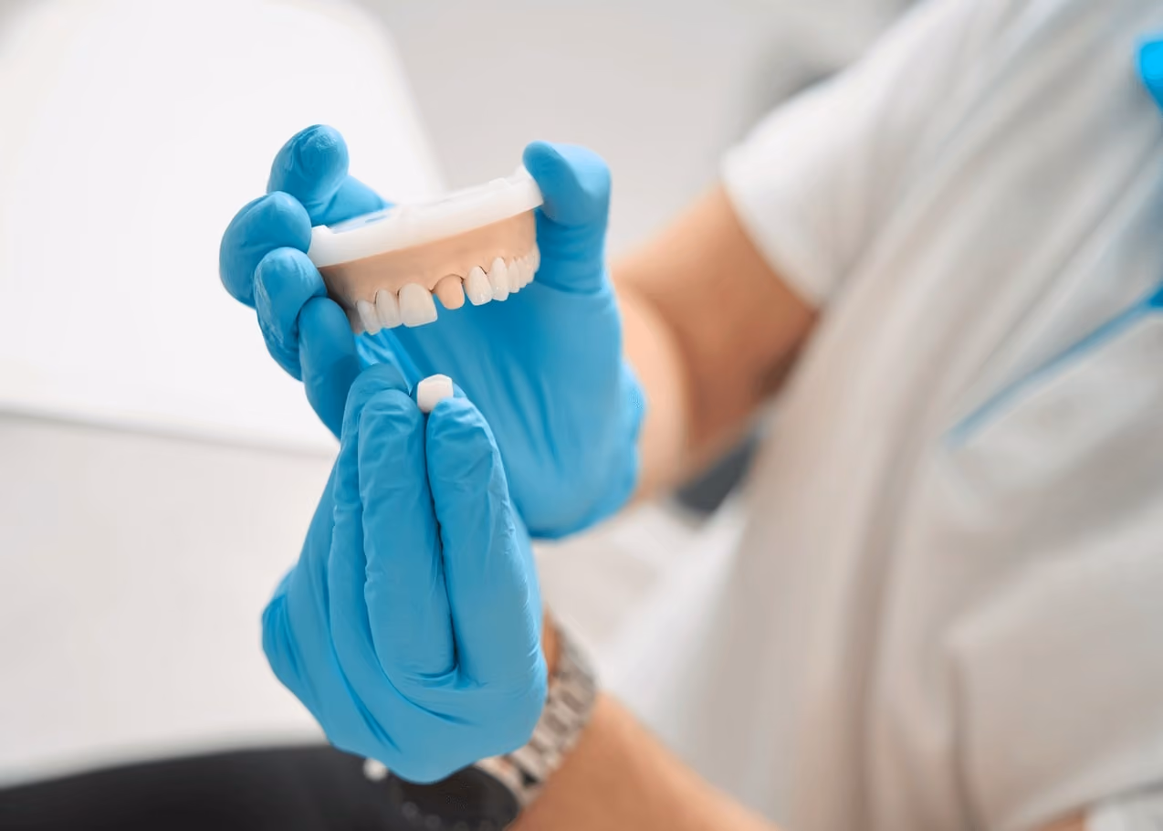 A dentist uses a model of teeth to explain how a dental crown is placed at the best dentist in San Francisco
