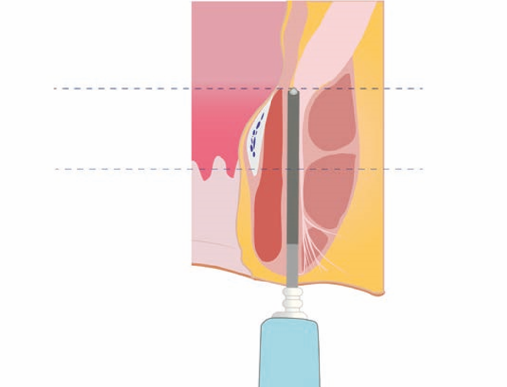 step_full_insertion.png