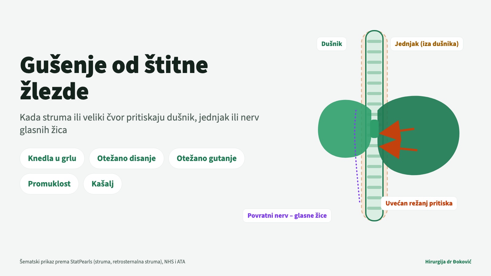 Gušenje od štitne žlezde: šematski prikaz uvećane štitne žlezde koja pritiska dušnik, jednjak i povratni nerv glasnih žica, uz tegobe kao što su knedla u grlu, otežano disanje i gutanje, promuklost i kašalj