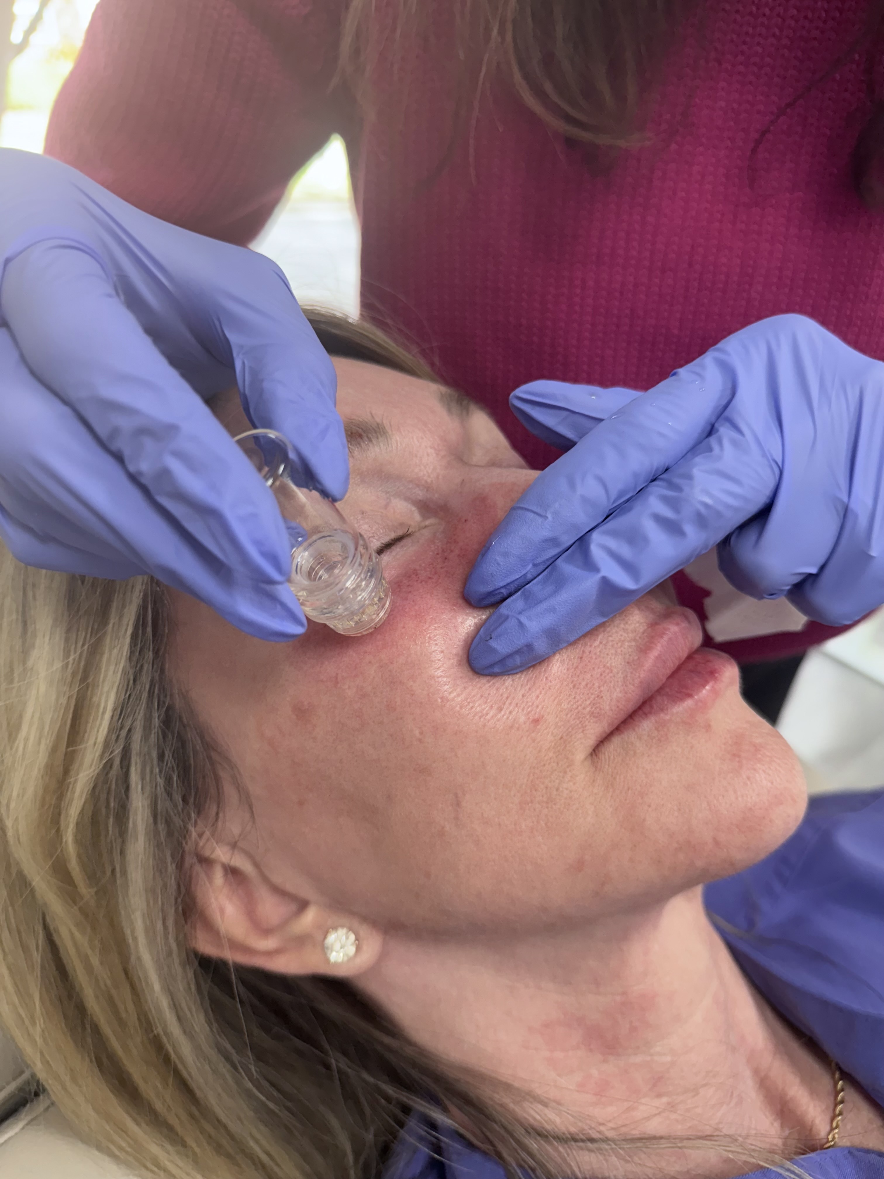 Technician performing PRP Injection for hair growth