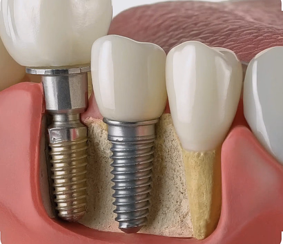 Dentures in Huntington | Shore Dental Solution
