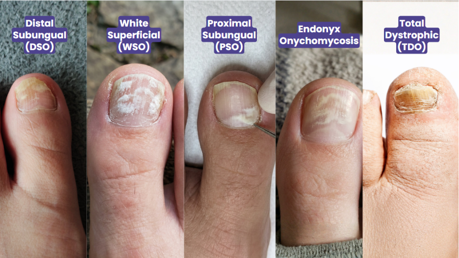 Image showing different types of toenail fungus, including DSO, WSO, PSO, Endonyx, and Total Dystrophic forms