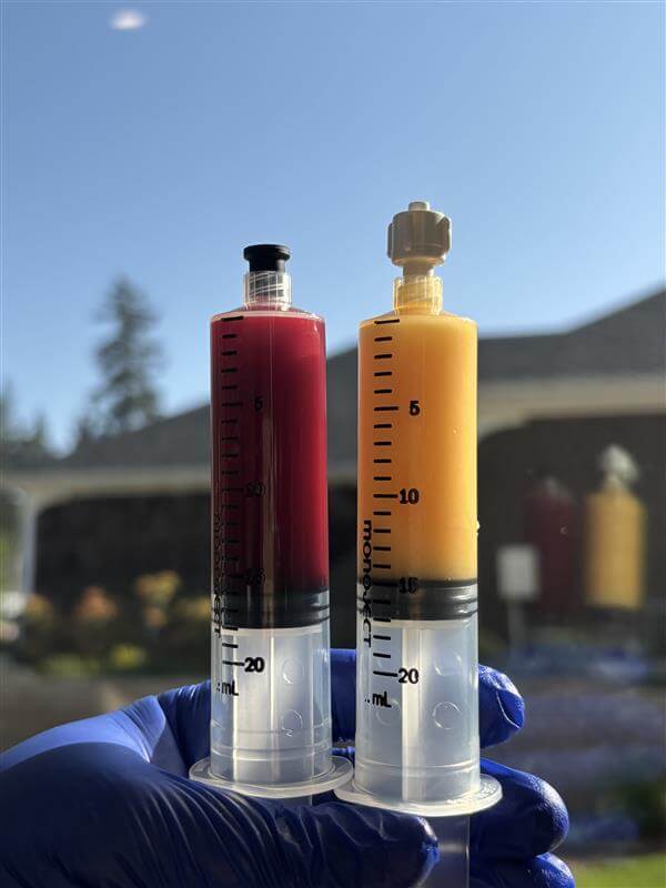 Platelet Rich Plasma (PRP) andMicro Fragmented Fat (MFAT Stem Cells)