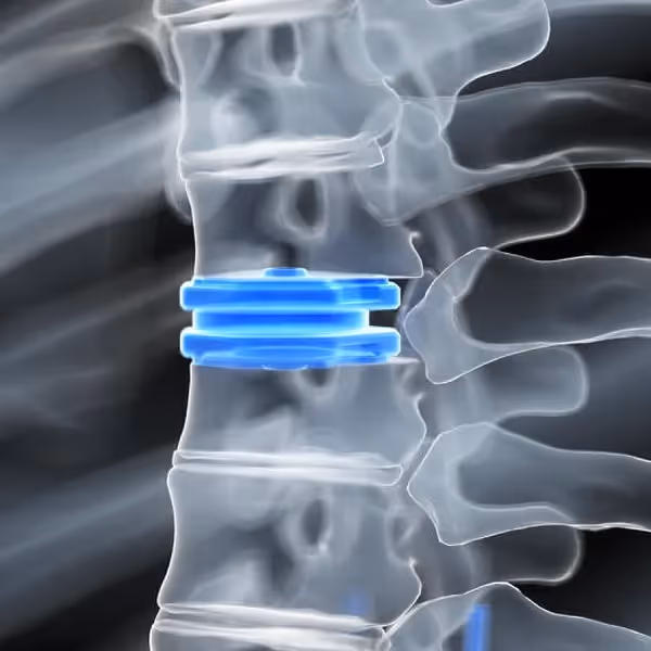 3D illustration of spinal discs in the lumbar region