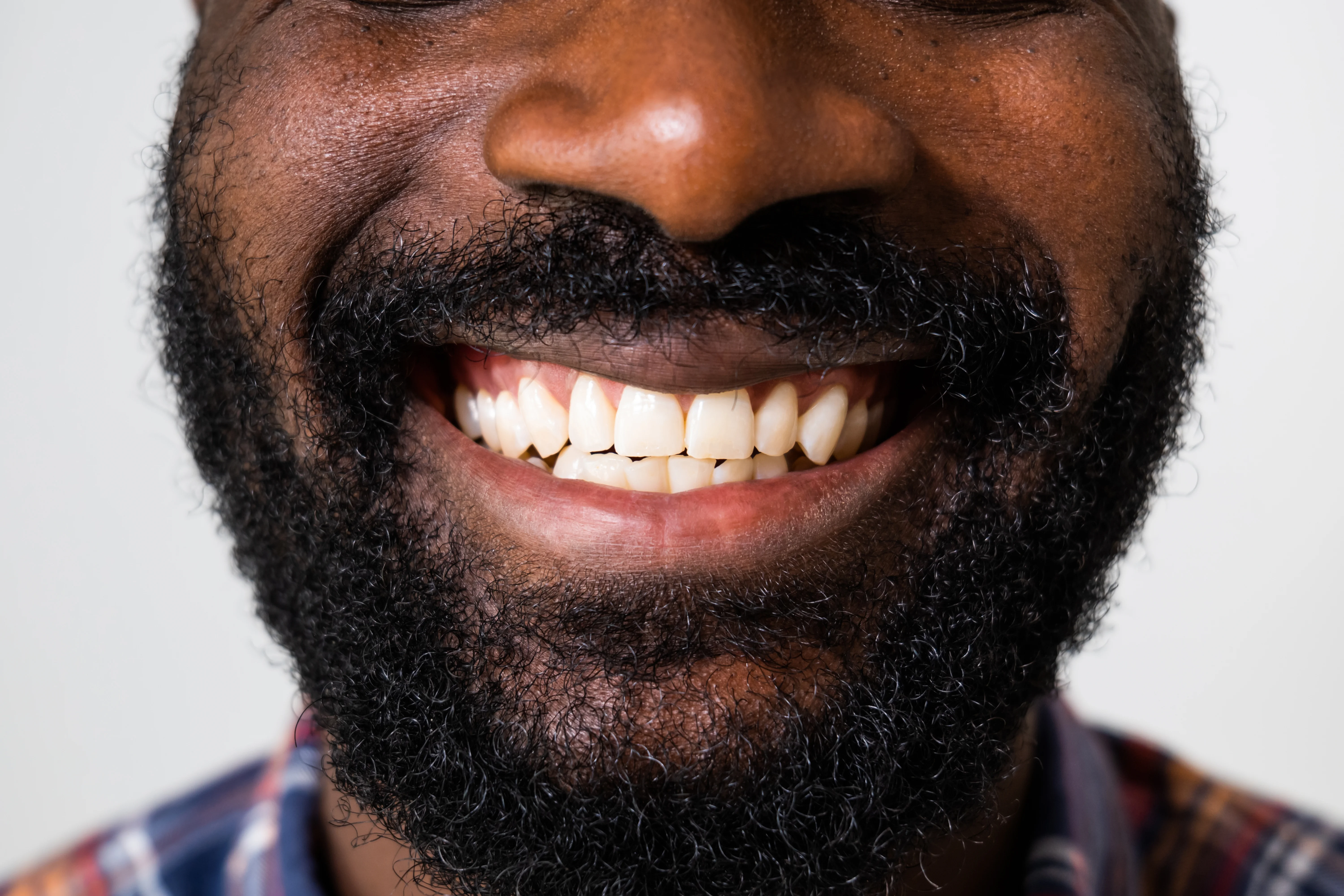Close-up of upper and lower front teeth showing protrusion