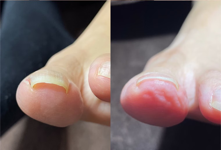 軽度の巻き爪の矯正前後｜爪の端が皮膚に沈んだ足の親指と矯正後の比較