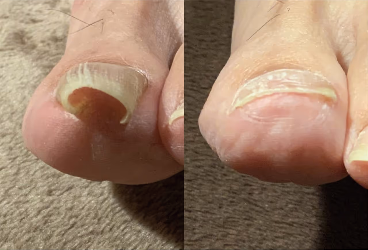 重度の巻き爪の矯正前後｜深く巻き込み皮膚を覆った爪と矯正後の比較