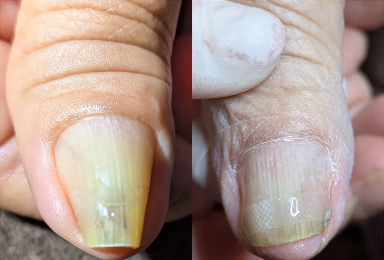 手の爪の巻き爪矯正前後｜厚みのある手の親指の爪と施術後の比較