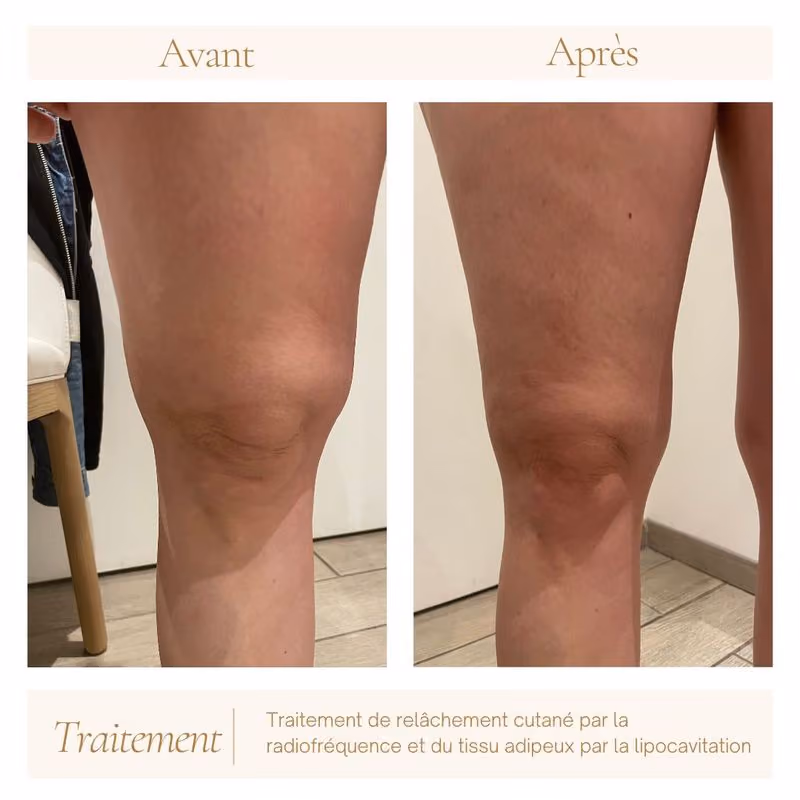 avant-apres-cryolipolyse-mandelieu