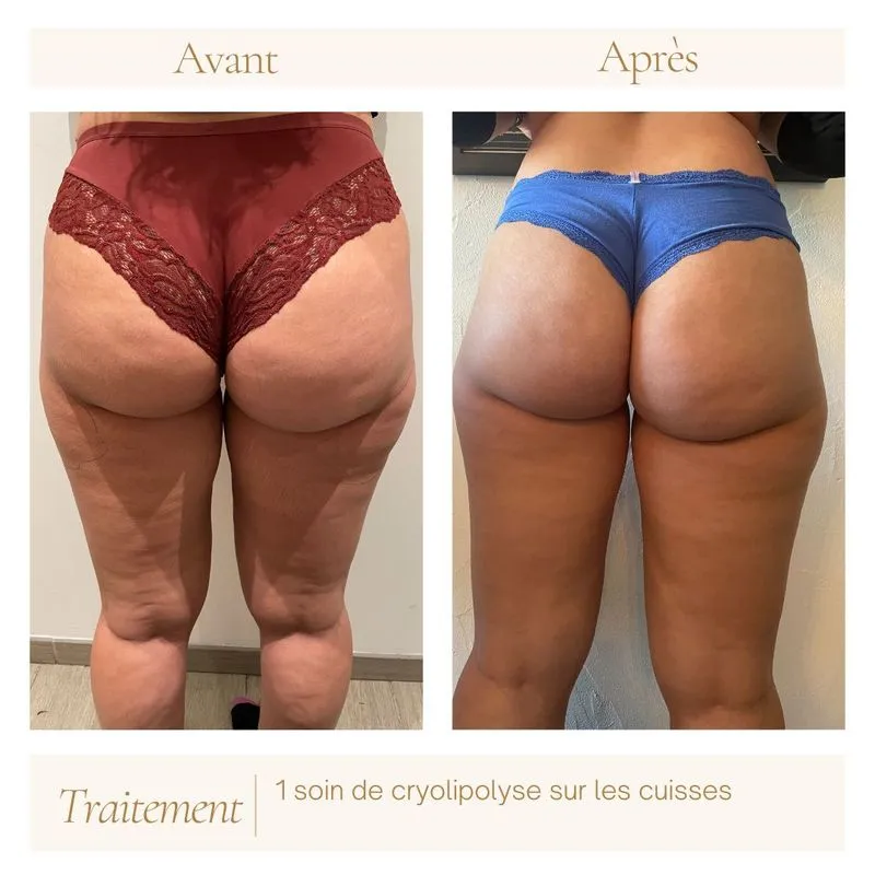 avant-apres-cryolipolyse-mandelieu