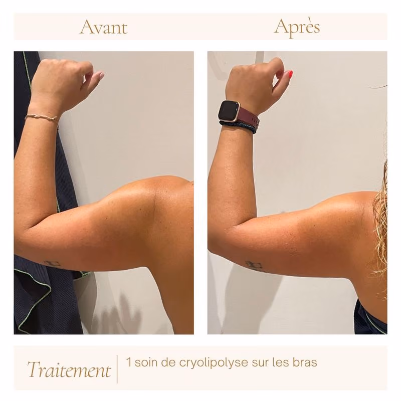 avant-apres-cryolipolyse-mandelieu